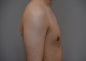 Gynecomastia Before & After Patient #1160