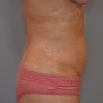 Liposuction with Bodytite Before & After Patient #1558