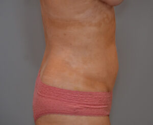 Liposuction with Bodytite Before & After Patient #1558