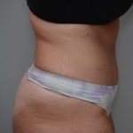 Abdominoplasty Before & After Patient #1496