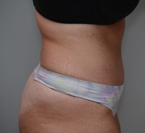 Abdominoplasty Before & After Patient #1496