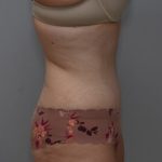 Abdominoplasty Before & After Patient #1495