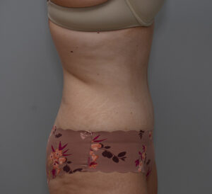 Abdominoplasty Before & After Patient #1495