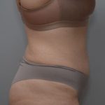 Abdominoplasty Before & After Patient #1494