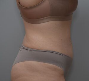 Abdominoplasty Before & After Patient #1494