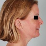 Face And Neck Lift Before & After Patient #1743