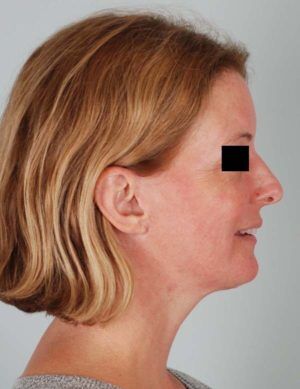 Face And Neck Lift Before & After Patient #1743