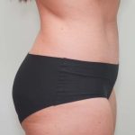 Abdominoplasty Before & After Patient #1326