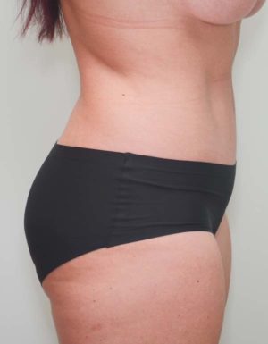 Abdominoplasty Before & After Patient #1326