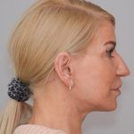 Face And Neck Lift Before & After Patient #1745