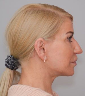 Face And Neck Lift Before & After Patient #1745