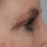 Blepharoplasty Before & After Patient #1704