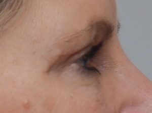 Blepharoplasty Before & After Patient #1704