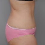 Abdominoplasty Before & After Patient #1271