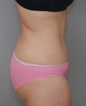 Abdominoplasty Before & After Patient #1271