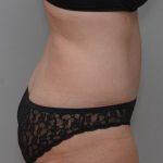 Abdominoplasty Before & After Patient #1387