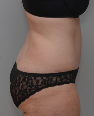 Abdominoplasty Before & After Patient #1644