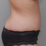 Abdominoplasty Before & After Patient #1440