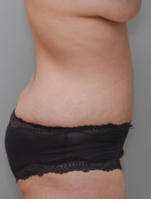 Abdominoplasty Before & After Patient #1440
