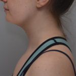 Neck Liposuction Before & After Patient #1952