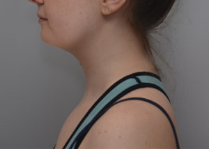 Neck Liposuction Before & After Patient #1952