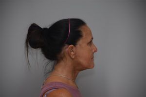 Face And Neck Lift Before & After Patient #1744