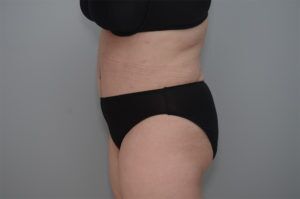 Abdominoplasty Before & After Patient #1210