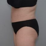 Abdominoplasty Before & After Patient #1589