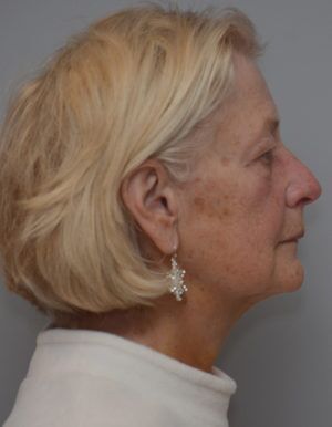 Facetite Before & After Patient #1777