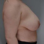 Breast Reduction Before & After Patient #1131