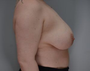 Breast Reduction Before & After Patient #1131