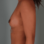 Breast Augmentation Before & After Patient #359