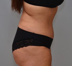 Abdominoplasty Before & After Patient #1443