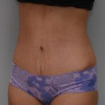 Abdominoplasty Before & After Patient #1441