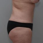 Abdominoplasty Before & After Patient #1444