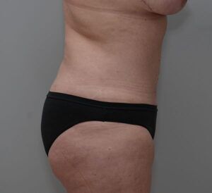 Abdominoplasty Before & After Patient #1444