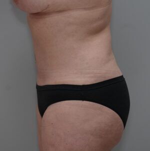 Bodytite Before & After Patient #1556