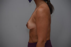 Breast Augmentation Before & After Patient #249