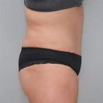 Abdominoplasty Before & After Patient #1273