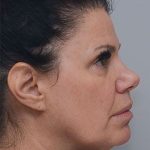 Laser Skin Resurfacing Before & After Patient #2230