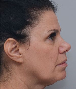 Laser Skin Resurfacing Before & After Patient #2230