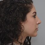 Rhinoplasty Before & After Patient #2114