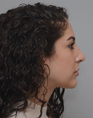 Rhinoplasty Before & After Patient #2114