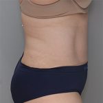 Abdominoplasty Before & After Patient #1383