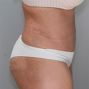 Abdominoplasty Before & After Patient #1329