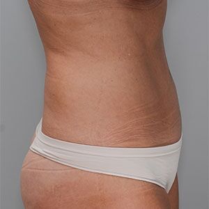 Abdominoplasty Before & After Patient #1328