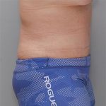 Abdominoplasty Before & After Patient #1272