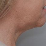 Facetite Before & After Patient #1882