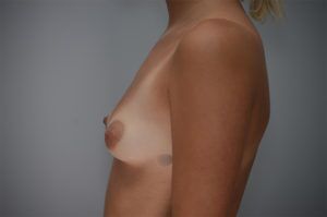Breast Augmentation Before & After Patient #301