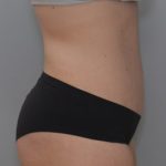 Abdominoplasty Before & After Patient #1385